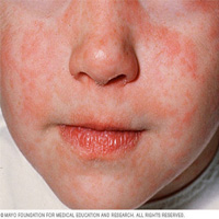 Closeupofchildfacewithmeasles