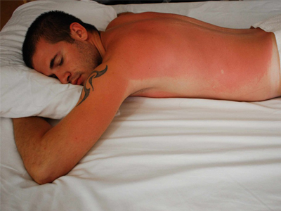 Sunburn_medium