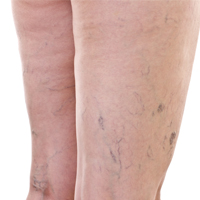 varicose veins_small.