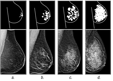 乳房密度成像类别