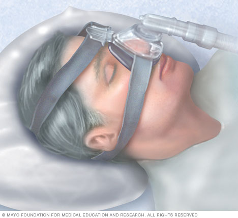 持续气道正压(CPAP)